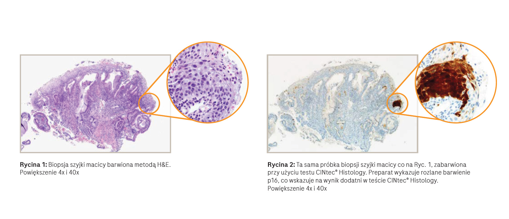 Test CINtec® Histology — barwienie p16 w preparacie z biopsji szyjki macicy