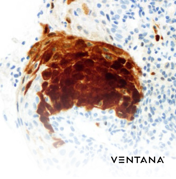 Diagnostyka — CINtec Histology